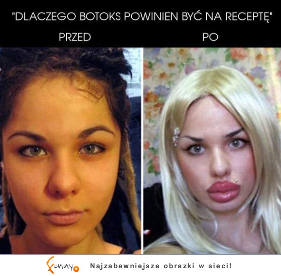 Botoks - Przed i po :)