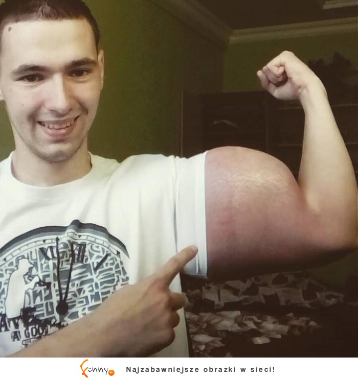 Wstrzykiwał sobie synthol, żeby powiększyć biceps! O mały włos nie zszedł z tego świata!