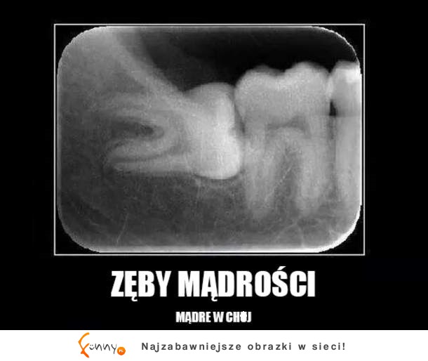 Zęby mądrości