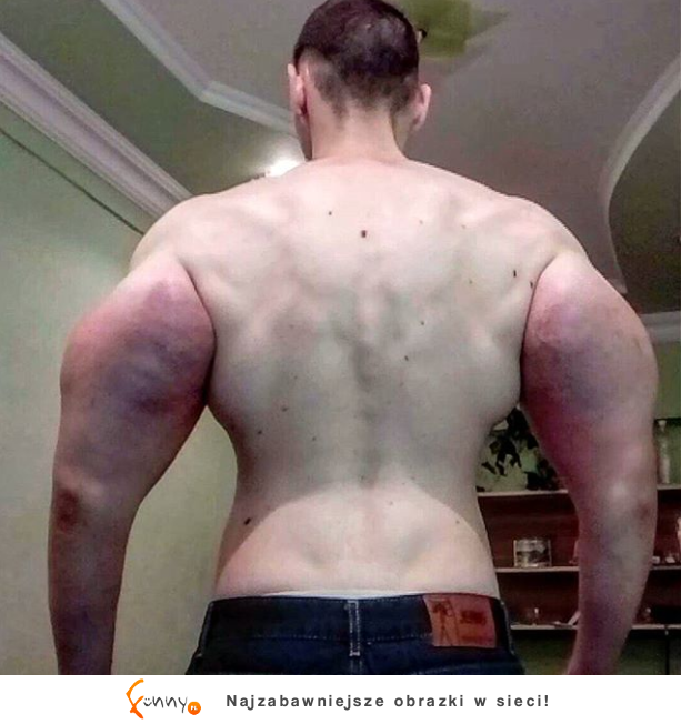 Wstrzykiwał sobie synthol, żeby powiększyć biceps! O mały włos nie zszedł z tego świata!