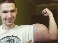 Wstrzykiwał sobie synthol, żeby powiększyć biceps! O mały włos nie zszedł z tego świata!