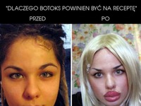 Botoks - Przed i po :)